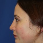Rhinoplasty Before & After Patient #3686