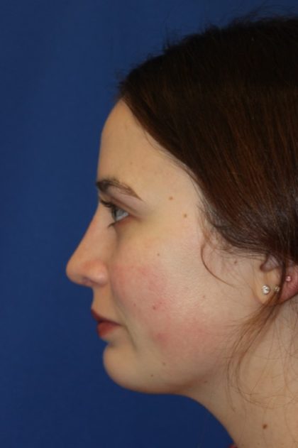 Rhinoplasty Before & After Patient #3686
