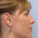 Rhinoplasty Before & After Patient #3963