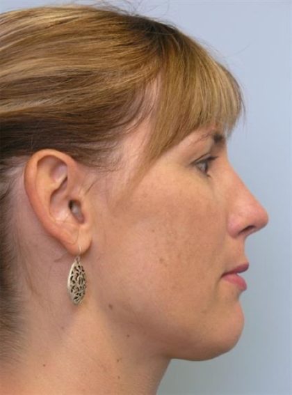 Rhinoplasty Before & After Patient #3963