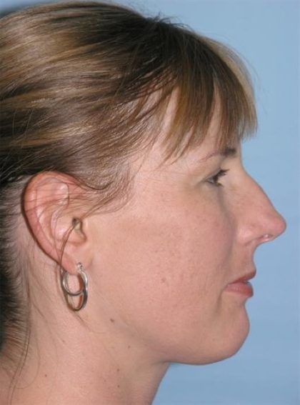 Rhinoplasty Before & After Patient #3963