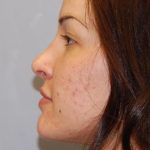 Rhinoplasty Before & After Patient #4134