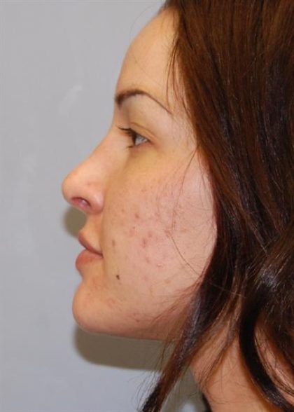 Rhinoplasty Before & After Patient #4134