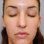 Rhinoplasty Before & After Patient #4134