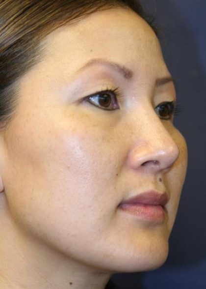Rhinoplasty Before & After Patient #4055