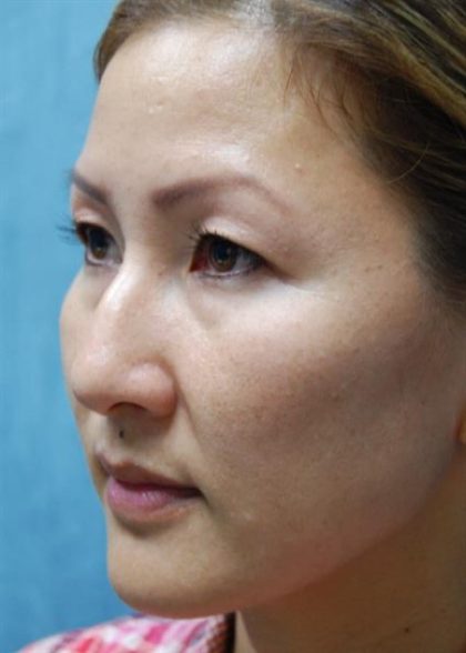 Rhinoplasty Before & After Patient #4055