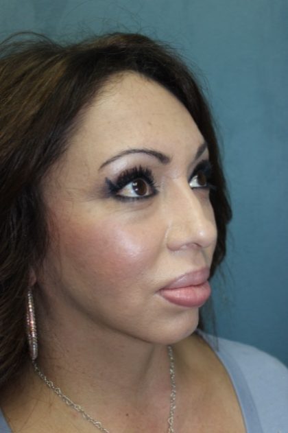 Rhinoplasty Before & After Patient #3776