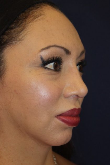 Rhinoplasty Before & After Patient #3776