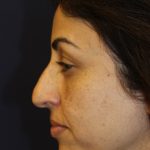 Rhinoplasty Before & After Patient #3914