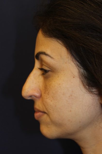 Rhinoplasty Before & After Patient #3914