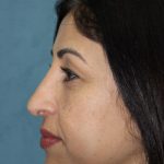 Rhinoplasty Before & After Patient #3914