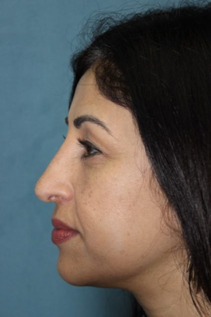Rhinoplasty Before & After Patient #3914