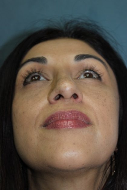 Rhinoplasty Before & After Patient #3914