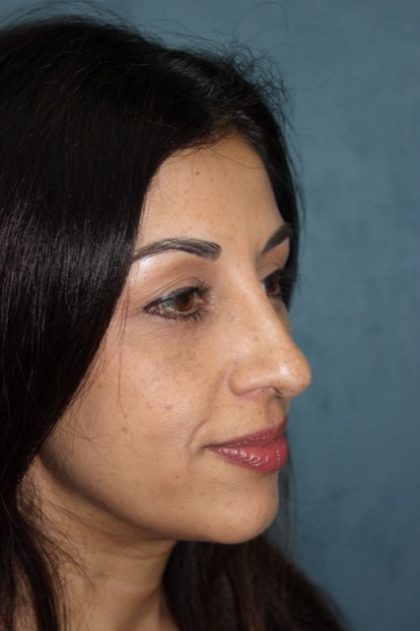 Rhinoplasty Before & After Patient #3914