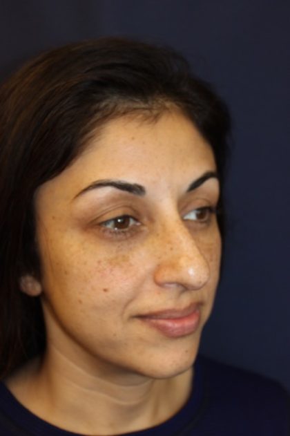 Rhinoplasty Before & After Patient #3914