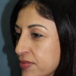 Rhinoplasty Before & After Patient #3914