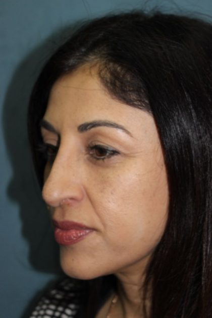 Rhinoplasty Before & After Patient #3914