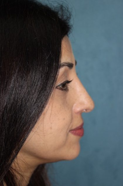 Rhinoplasty Before & After Patient #3914