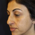 Rhinoplasty Before & After Patient #3914