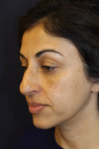 Rhinoplasty Before & After Patient #3914