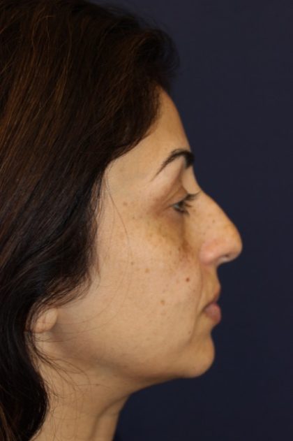 Rhinoplasty Before & After Patient #3914