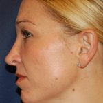 Rhinoplasty Before & After Patient #3861