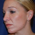 Rhinoplasty Before & After Patient #3861