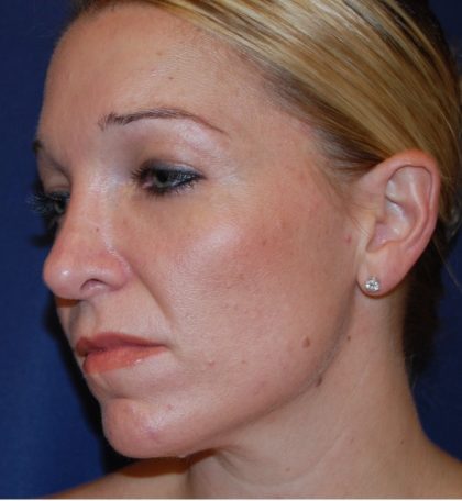 Rhinoplasty Before & After Patient #3861