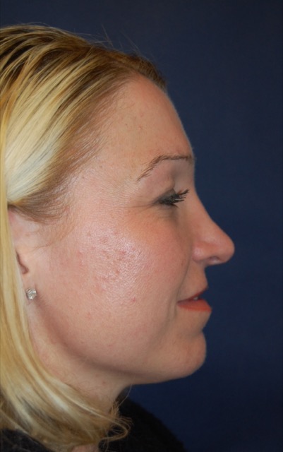 Rhinoplasty Before & After Patient #3861