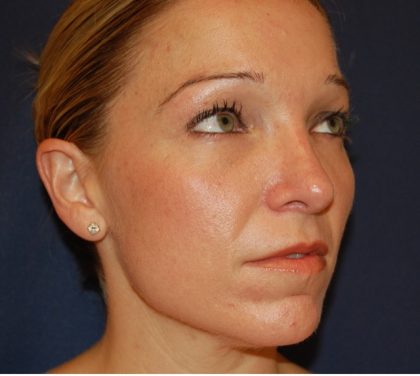 Rhinoplasty Before & After Patient #3861