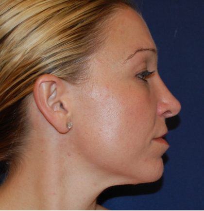 Rhinoplasty Before & After Patient #3861