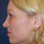 Rhinoplasty Before & After Patient #3861