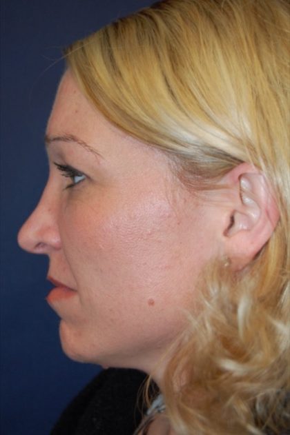 Rhinoplasty Before & After Patient #3861