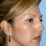 Rhinoplasty Before & After Patient #3936