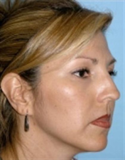 Rhinoplasty Before & After Patient #3936