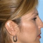 Rhinoplasty Before & After Patient #3936