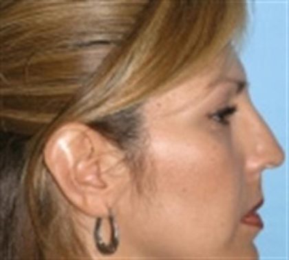 Rhinoplasty Before & After Patient #3936