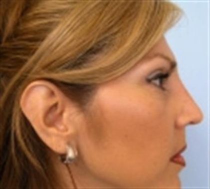 Rhinoplasty Before & After Patient #3936