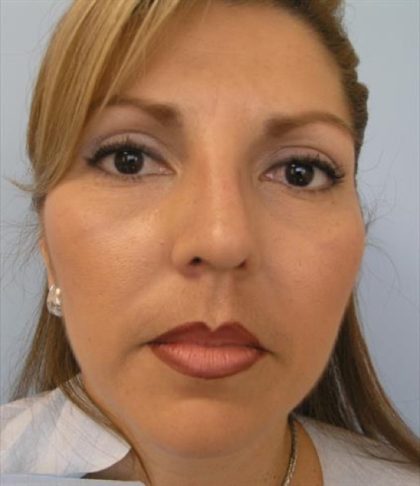 Rhinoplasty Before & After Patient #3936