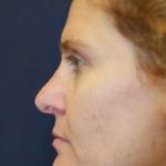 Revision Rhinoplasty Before & After Patient #4063