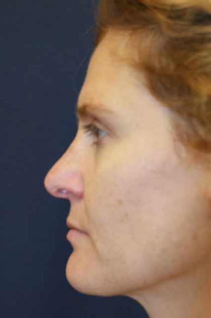 Revision Rhinoplasty Before & After Patient #4063