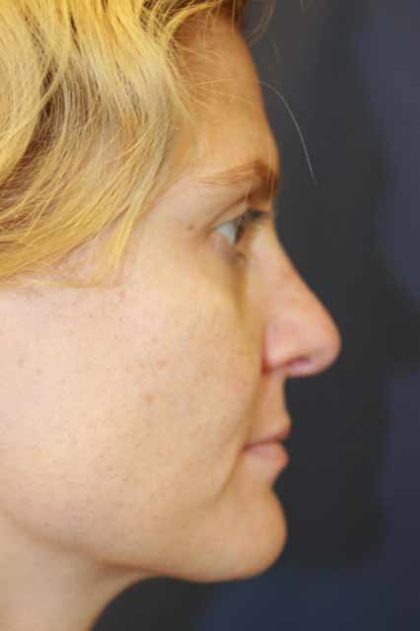 Revision Rhinoplasty Before & After Patient #4063