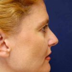 Revision Rhinoplasty Before & After Patient #4063