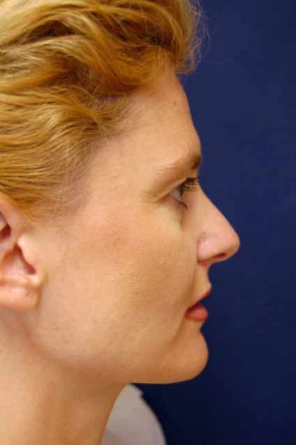 Revision Rhinoplasty Before & After Patient #4063