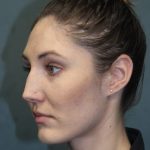 Rhinoplasty Before & After Patient #3710