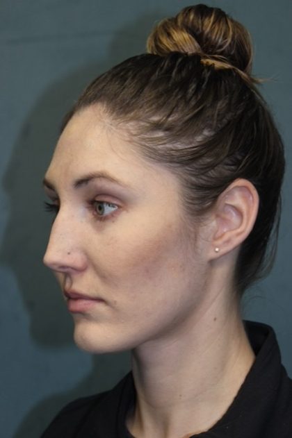 Rhinoplasty Before & After Patient #3710