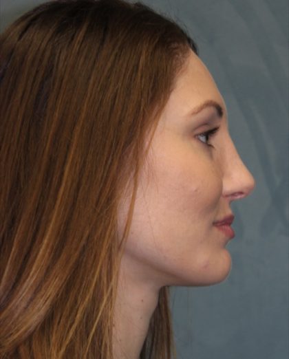 Rhinoplasty Before & After Patient #3710