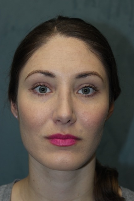 Rhinoplasty Before & After Patient #3710