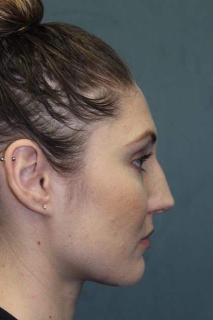 Rhinoplasty Before & After Patient #3710