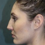 Rhinoplasty Before & After Patient #3710